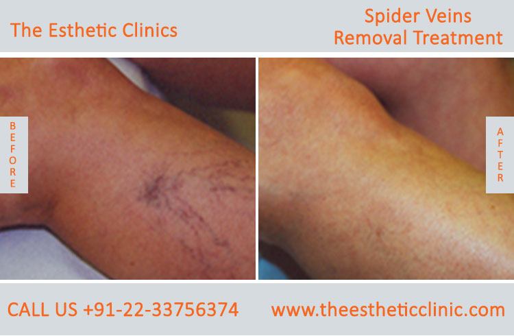 Spider Veins Removal Varicose Veins Laser Treatment before after photos mumbai india (1 (3)